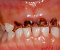 پیشگیری از پوسیدگی زودرس دندان کودکان
